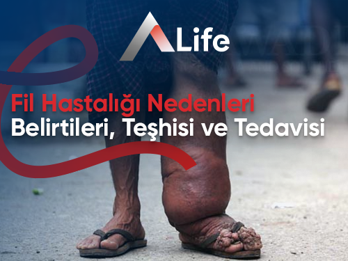 Fil Hastalığı Nedenleri, Belirtileri, Teşhisi ve Tedavisi